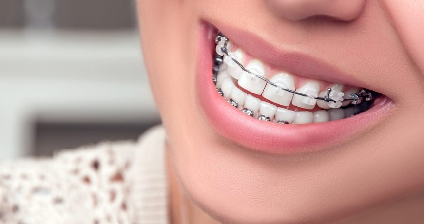 ortodontie aparat dentar